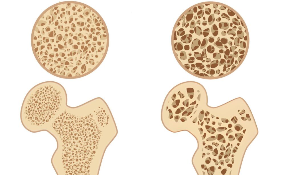 Osteoporosis