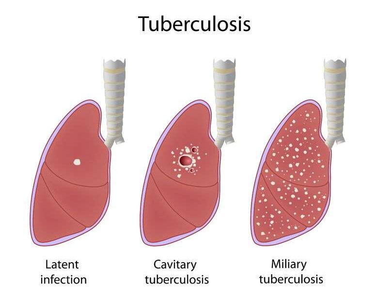 TB test Kitchener